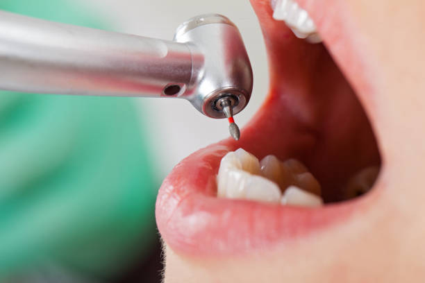 Best Emergency Treatment for Toothache in Laguna Beach, CA